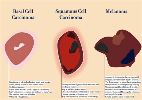 Details 60 Squamous Cell Carcinoma Histology Drawing Nhadathoanghavn