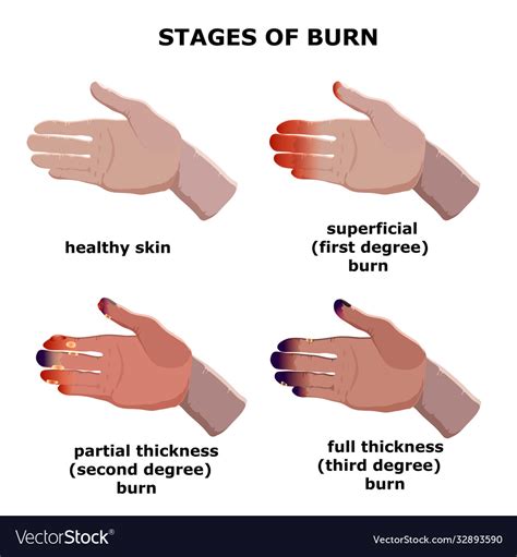 Medical Burn Stages Degree Burns Royalty Free Vector Image