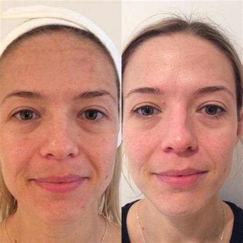 Hydrafacial Treatment London Skin Clinic Hydrafacial In Harley Street