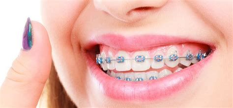 Doktergigi Id Tempat Pemasangan Behel Gigi Terbaik Di Malang Ilmu