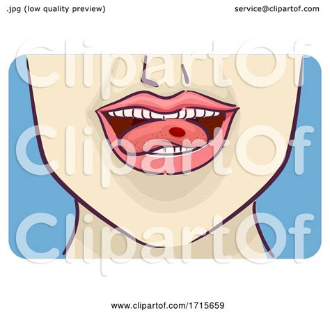 Symptom Red Blood Blister Side Tongue Illustration By Bnp Design Studio
