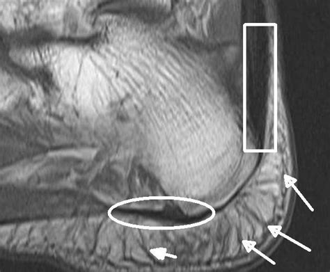 Plantar fasciitis is an extremely painful condition, and it is also difficult to treat for a variety of reasons. This is a MRI scan of the heel. Inside the white box is the Achilles tendon insertion. The round ...