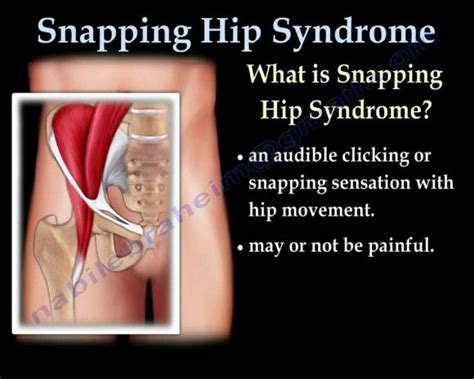 Snapping Hip Syndrome Everything You Need To Know Dr Nabil Ebraheim Psoasrelease With