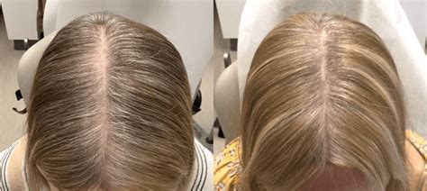 Alma Ted Hair Restore Procedure Benefits Recovery And Cost