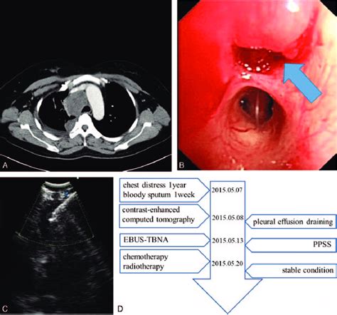 Can You Drain Lymph Nodes With A Needle Best Drain Photos Primagemorg