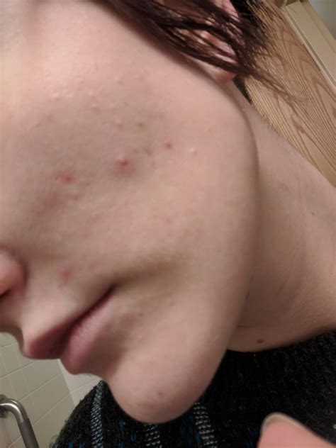 Acne Are These Bumps On My Face Closed Comedones I Cant Seem To Get Rid Of Them R