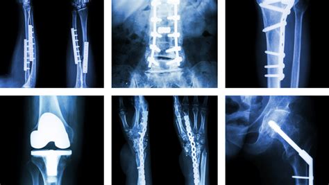 Orthopedic Imaging Hughston Clinic