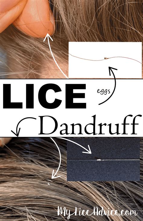 Lice Vs Dandruff 7 Key Differences Between Lice Eggs And Dandruff