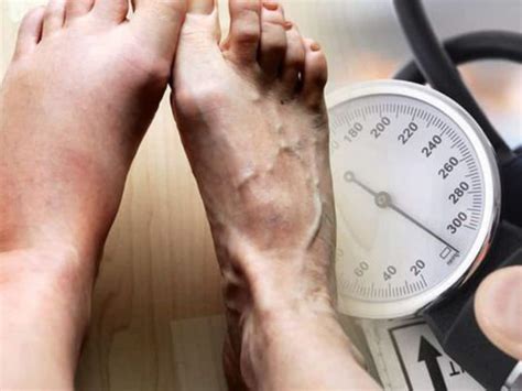 High Blood Pressure Symptoms 10 Signs That Can Appear In Your Legs And
