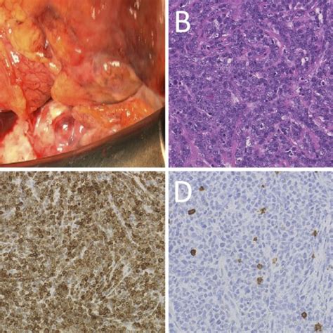 Figure4a Macroscopic Features Of The Cardiac Tumor During Surgery