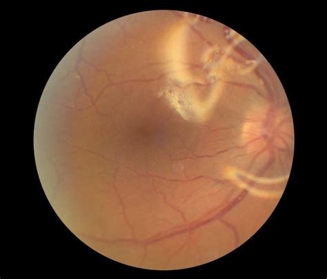 Dilated Fundus Exam Of The Right Eye Three Weeks Post Retinal