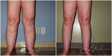 Lipedema Guidelines And Standards For Liposuction Lipedema Weight