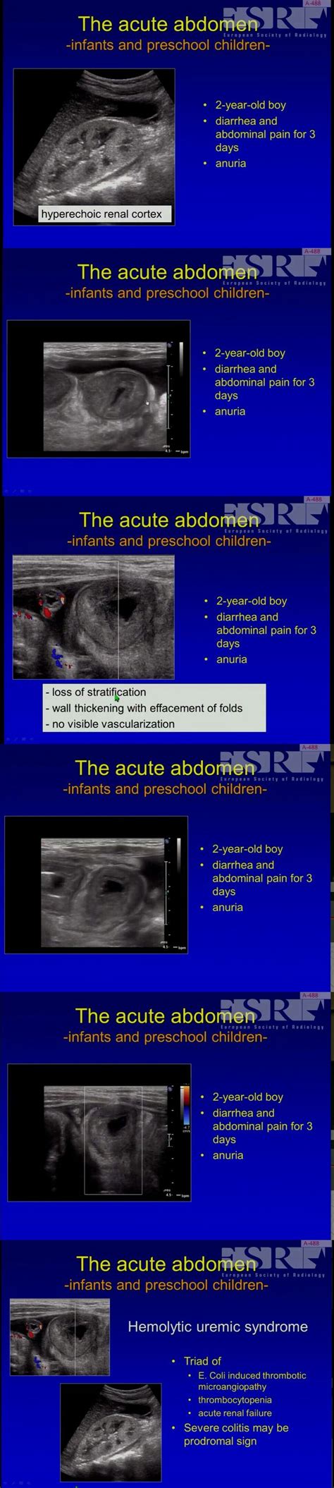 Ultrasound In Pediatric Abdomen Emergency Ultrasound Pediatrics