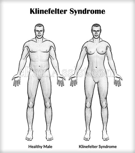Klinefelter Syndrome Genetics Disorders Icu Nursing