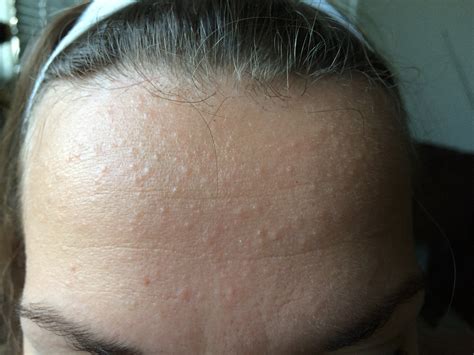 Small Flesh Colored Bumps On Forehead And Hairline Adult Acne