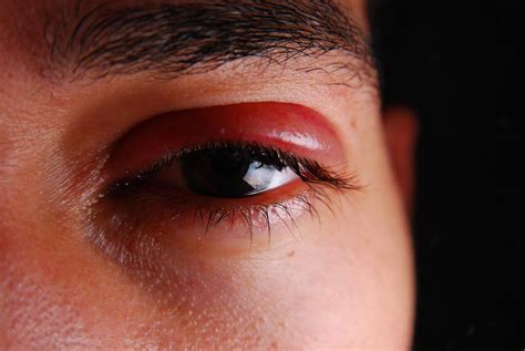 Shingles in the eye: Symptoms, treatment, and prevention