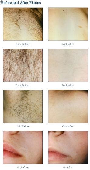 Collection Of Full Brazilian Hair Removal Video Full Brazilian Laser Hair Removal Before And