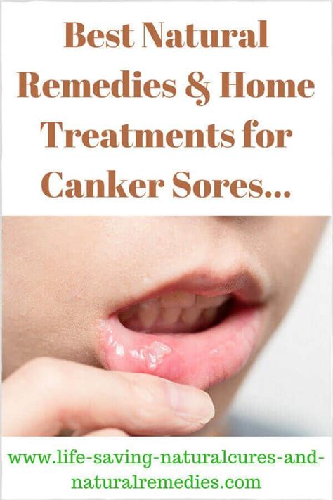 Top 10 Natural Home Remedies For Canker Sores And Mouth Ulcers