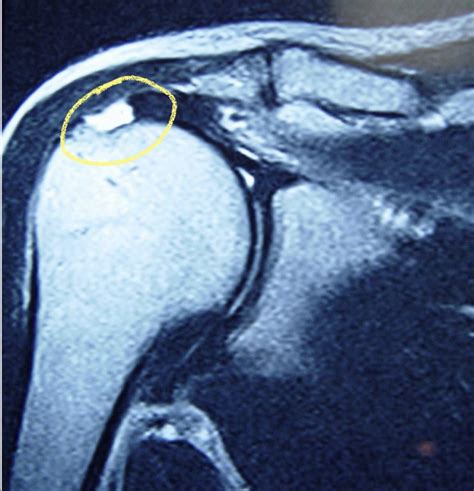 What Are Rotator Cuff Tear Symptoms Orthopaedic Specialists Pllc