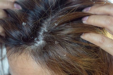 Update More Than 71 Itchy Scalp Hair Shedding Ineteachers