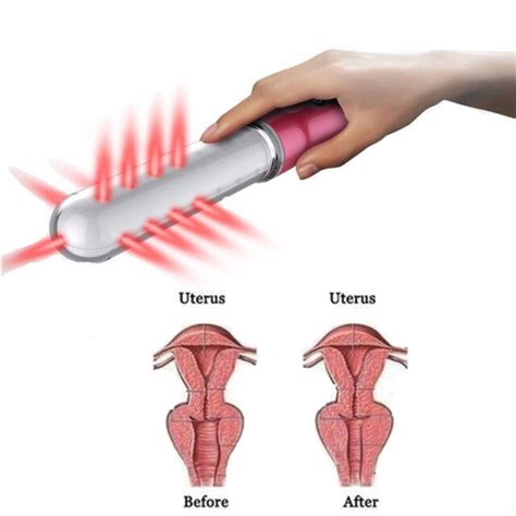 Vaginal Tightening Rejuvenation And Feminine Care Cold Laser Therapy