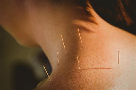 What Are The Benefits Of Acupuncture March With Us