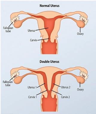 Uterus Didelphys Symptoms And Causes Being The Parent