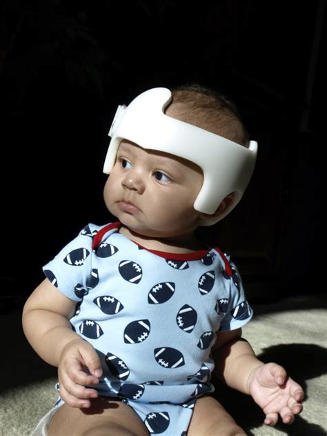 Babys Head Shape Flat Spots Torticollis And Helmets