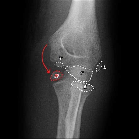 Epicondyle Fracture Elbow Radiology Reference Article Radiopaedia Org