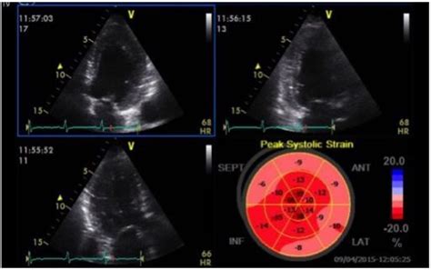 Strain Echocardiography In Acute Cardiovascular Diseases The Western
