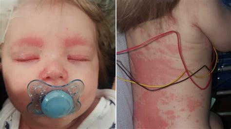 Meningitis Rash Completely Covers Babys Body In 12 Hours Mom Warns
