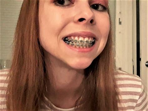 Pretty Smiles Teeth With Braces Porn Videos Newest Xxx Fpornvideos