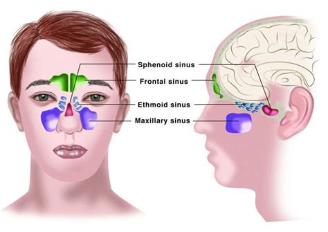 Sinusitis Cause Signs And Symptoms Diagnosis And Management
