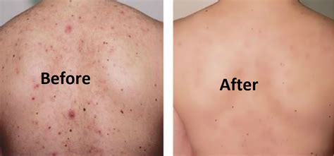 Get Rid Of White Acne Scars On Chest