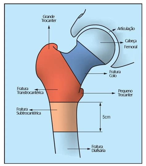 Quais São Os Tipos De Fratura Do Quadril Voglia Ortopedia 2023