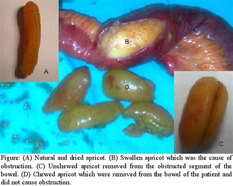 Either the small bowel or large bowel may be affected. JPMA - Journal Of Pakistan Medical Association