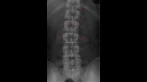 Lumbar Spine Radiology Tutorial Youtube