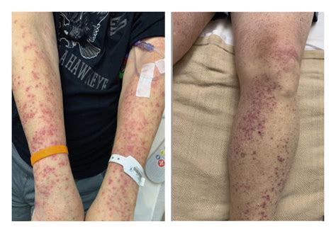 Maculopapular Rash In The Patients Bilateral Upper And Lower Extremities Download Scientific