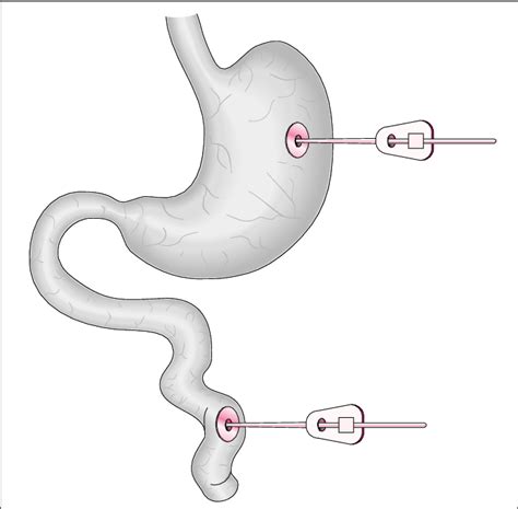 Figure 1 From Percutaneous Endoscopic Jejunostomy For Decompression In