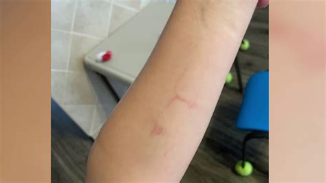 Child Comes Home With Mark On Arm After Coming From Collier Day Care