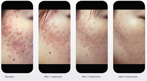 Dermovate For Acne Scars