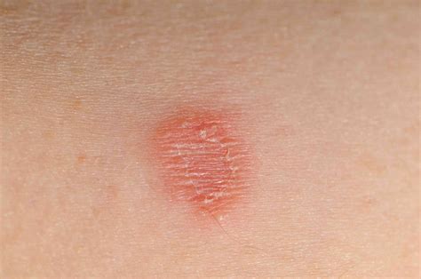 Ringworm Causes Symptoms And Treatment