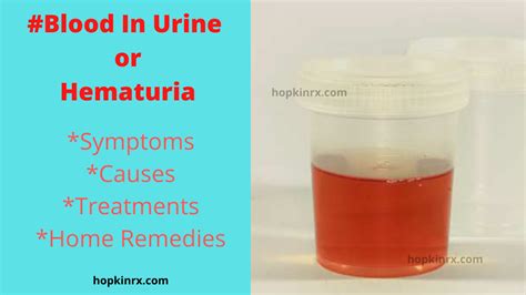 Blood In Urine Hematuria Symptoms Top 10 Causes Tests Treatments