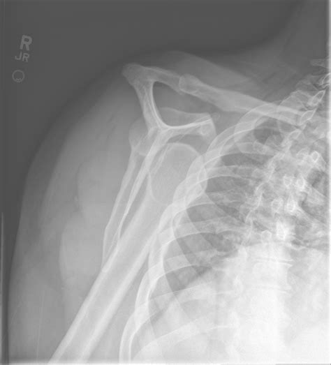 X Ray Shoulder Dislocation