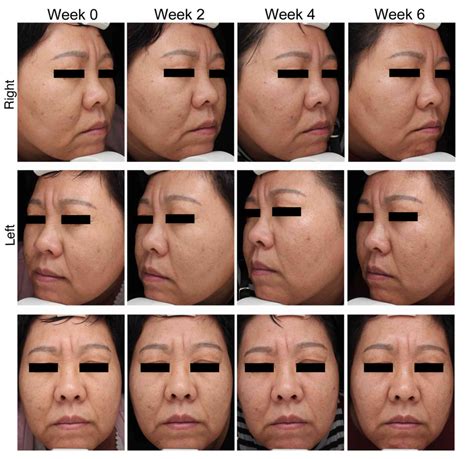 Effects Of Autologous Platelet‑rich Plasma Injections On Facial Skin