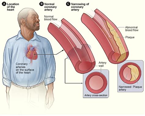 Coronary Artery Disease Cad Virginia Cardiovascular Specialists