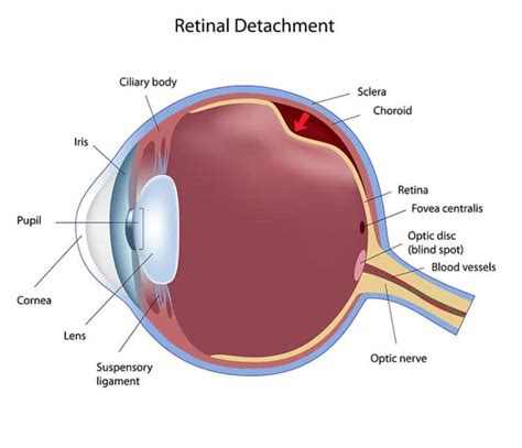 Retina Tears Detachment Center For Vitreo Retinal Diseases