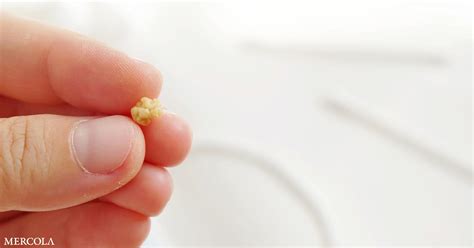 Are Tonsil Stones The Cause Of Your Bad Breath