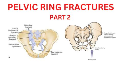PELVIC RING FRACTURES PART 1 EPISODE 1 YouTube