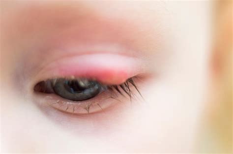 How To Prevent And Treat Styes Abc Childrens Eye Specialists